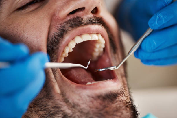 Best Emergency Dental Extractions in Lyndhurst, VA